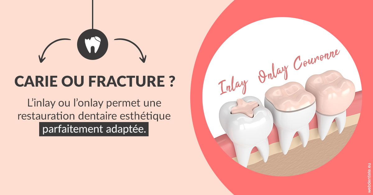 https://www.chirurgien-maxillo-facial-rouen.fr/T2 2023 - Carie ou fracture 2