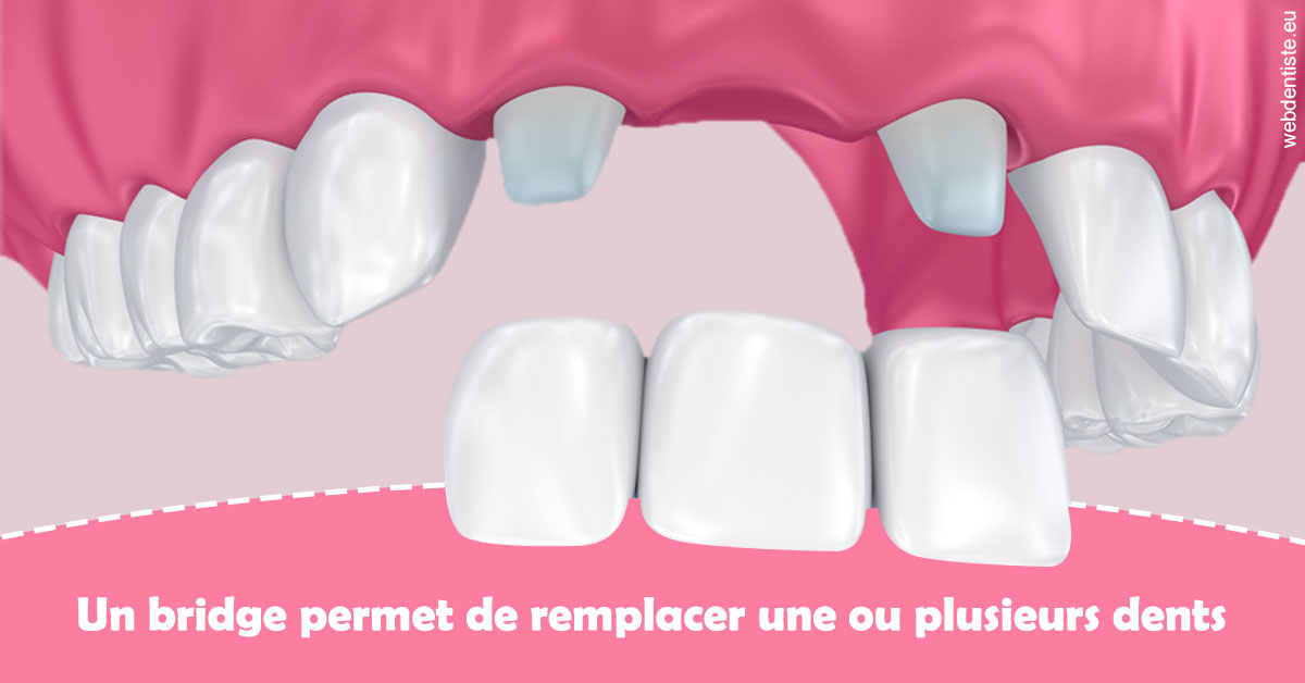 https://www.chirurgien-maxillo-facial-rouen.fr/Bridge remplacer dents 2