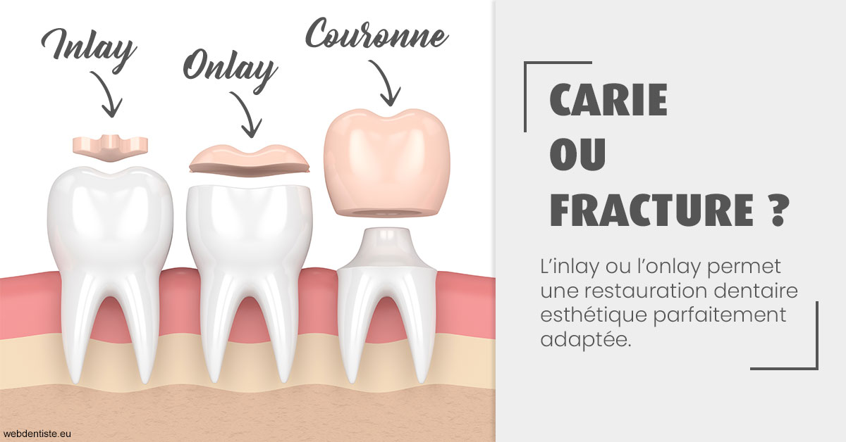 https://www.chirurgien-maxillo-facial-rouen.fr/T2 2023 - Carie ou fracture 1