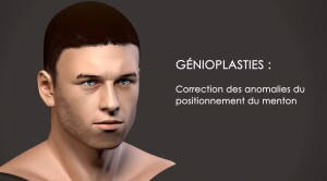 Génioplastie