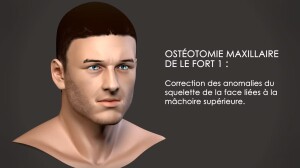 Ostéotomie maxillaire de Lefort I